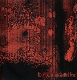 Melanocytic Tumors Of Uncertain Malignant Potential : Rocky Mountain Spotted Fever Melanocytic Tumors Of Uncertain Malignant Potential : Rocky Mountain Spotted Fever